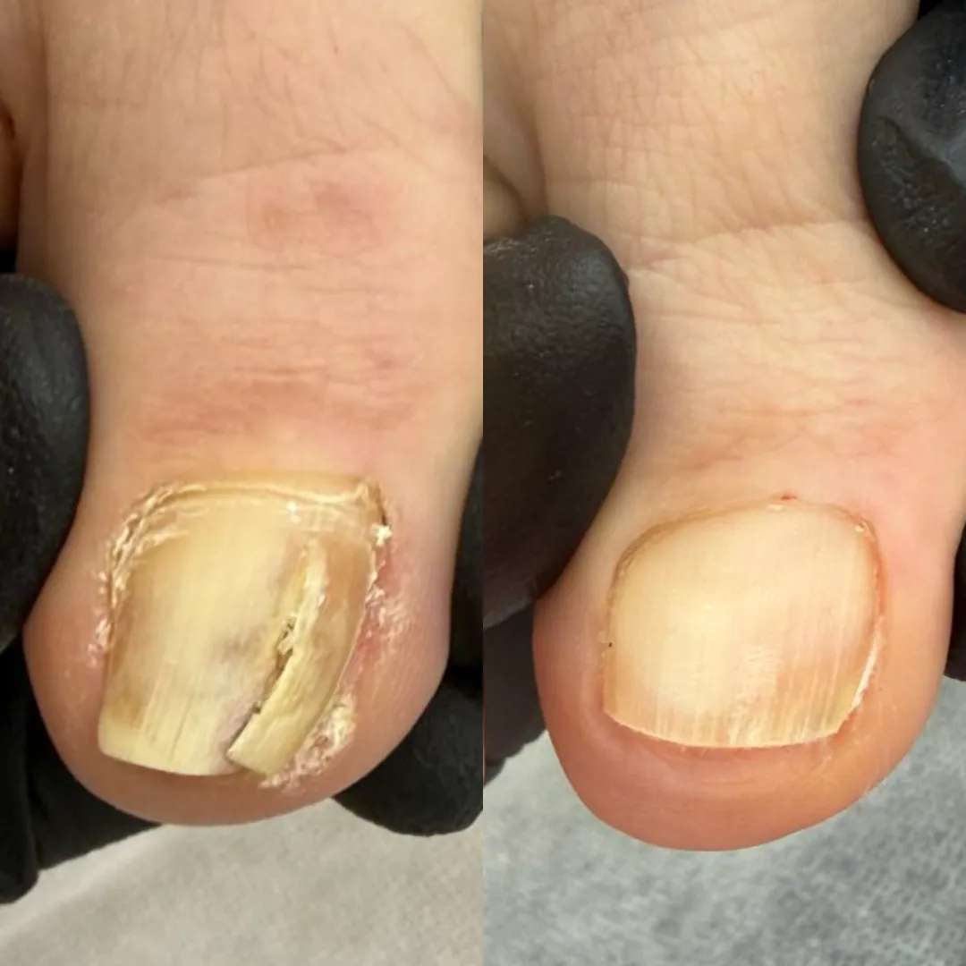 Specialist treating toenail concerns during a paramedical pedicure in Mississauga